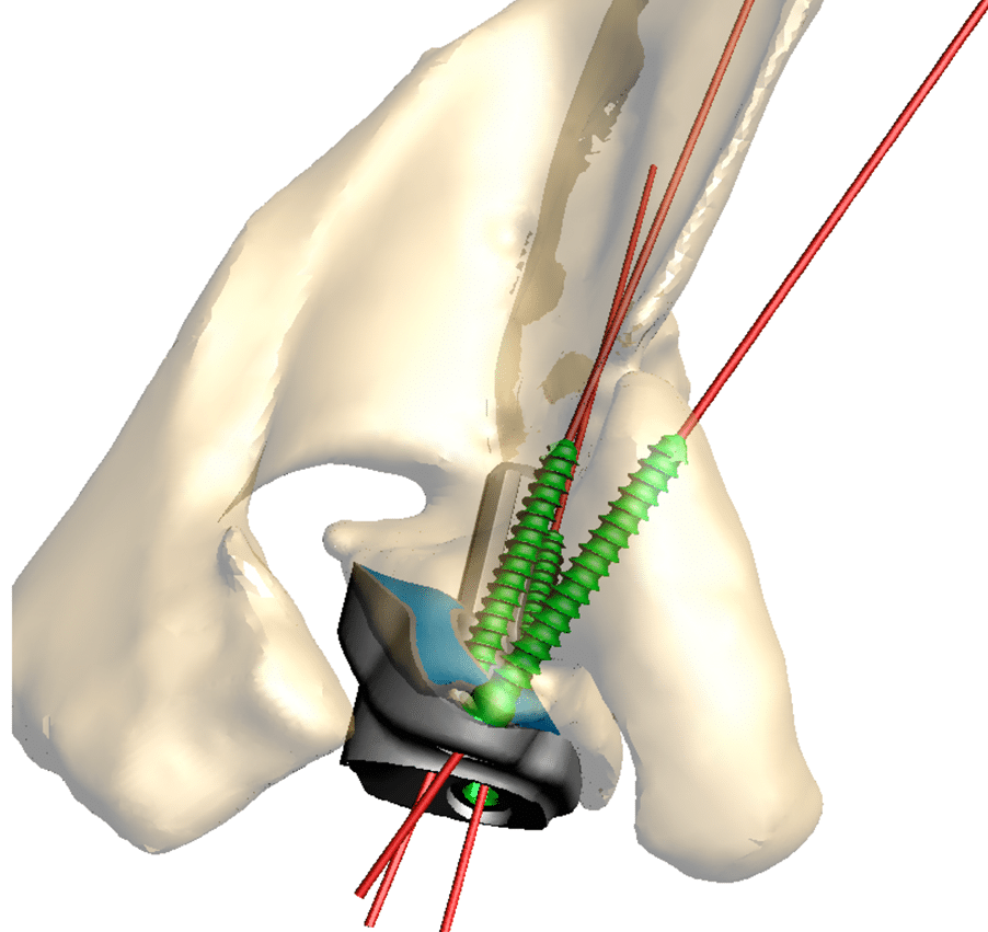 Shoulder replacement surgery Perth.