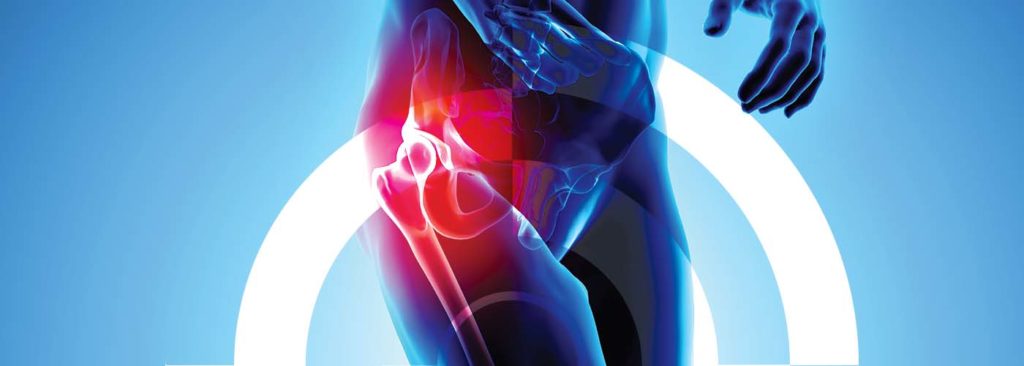 Hip pain requiring hip replacement