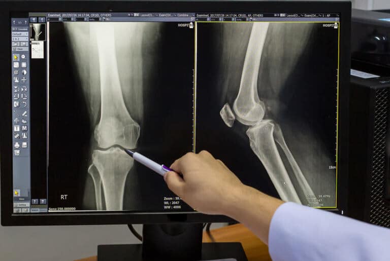 Knee xray Perth.